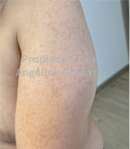 Queratosis pilaris